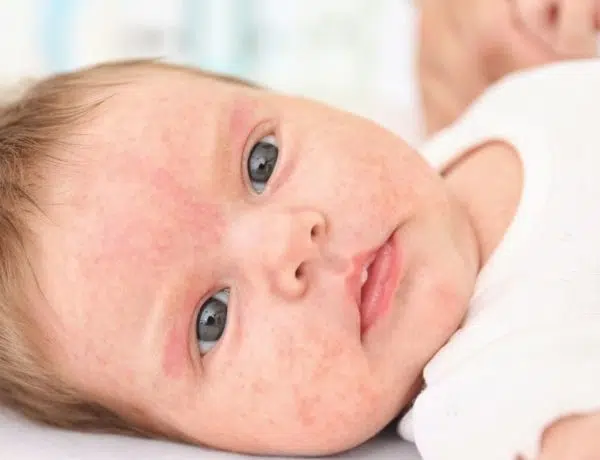 Hautprobleme bei Babys haben ihre Ursache häufig in Allergien