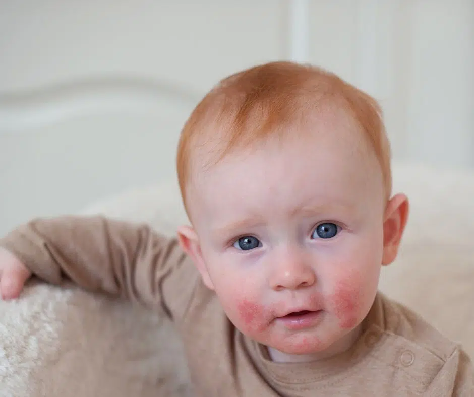 Hautprobleme bei Babys haben ihre Ursache häufig in Allergien